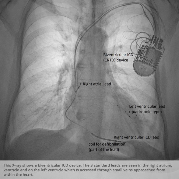 Biventricular ICD (CRTD) device