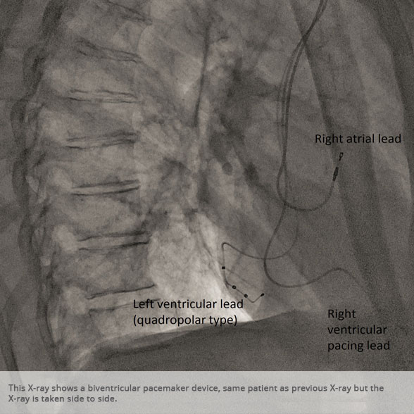 Lateral chest x-ray 2